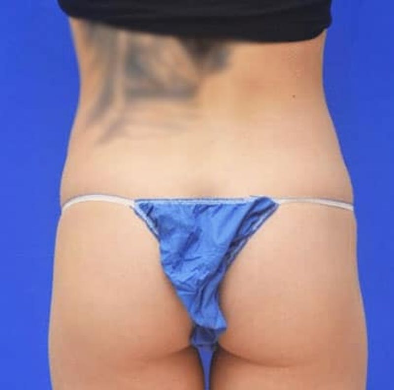 Liposuction Before & After Gallery - Patient 255729 - Image 7
