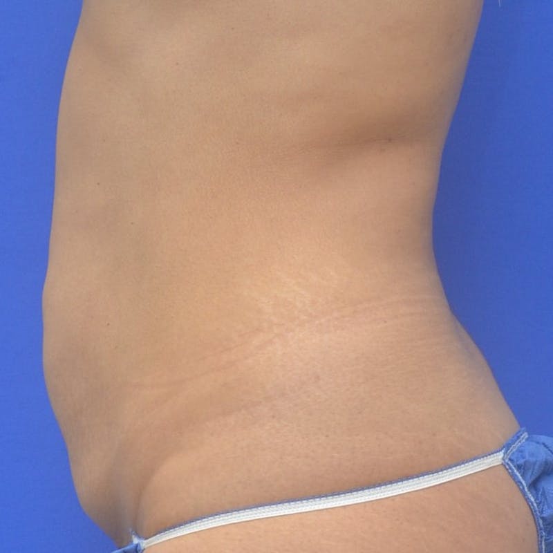 Liposuction Before & After Gallery - Patient 340359 - Image 3