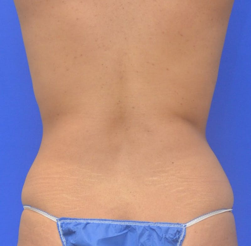 Liposuction Before & After Gallery - Patient 340359 - Image 5
