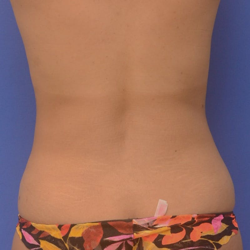 Liposuction Before & After Gallery - Patient 340359 - Image 6