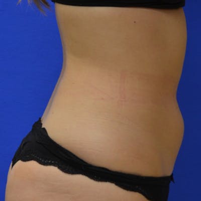 Liposuction Before & After Gallery - Patient 683599 - Image 1