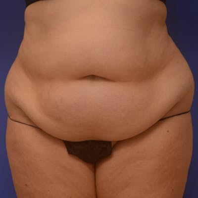 Liposuction Before & After Gallery - Patient 121264 - Image 1