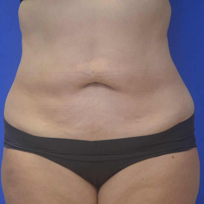Liposuction Before & After Gallery - Patient 121264 - Image 2