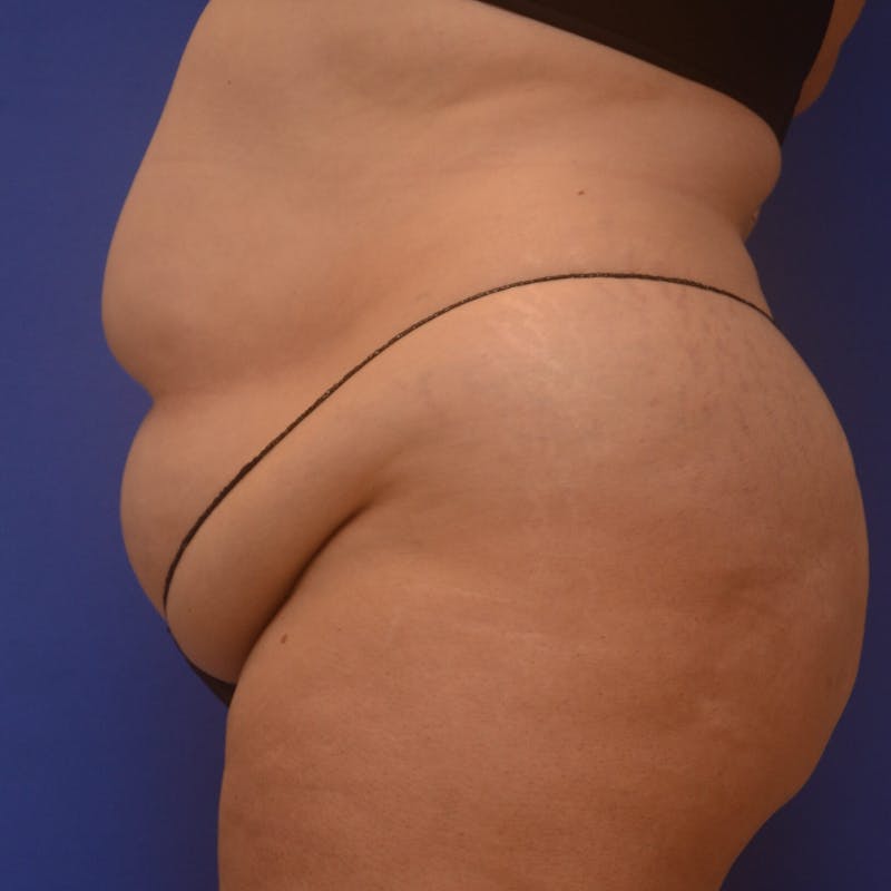 Liposuction Before & After Gallery - Patient 121264 - Image 3