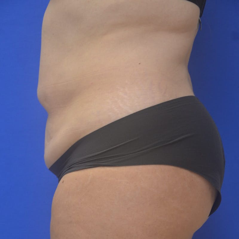 Liposuction Before & After Gallery - Patient 121264 - Image 4