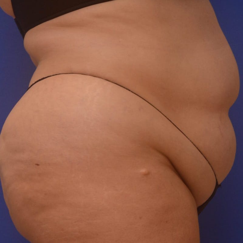 Liposuction Before & After Gallery - Patient 121264 - Image 5