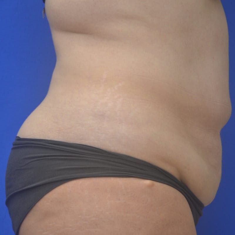 Liposuction Before & After Gallery - Patient 121264 - Image 6