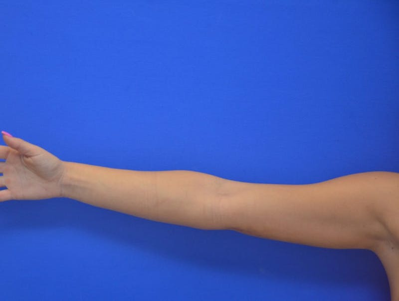 Liposuction Before & After Gallery - Patient 403247 - Image 7