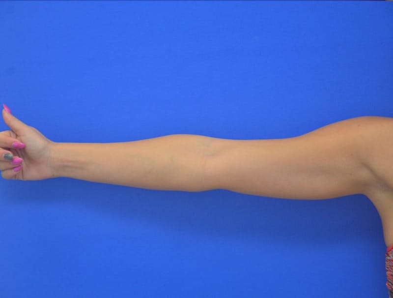 Liposuction Before & After Gallery - Patient 403247 - Image 8