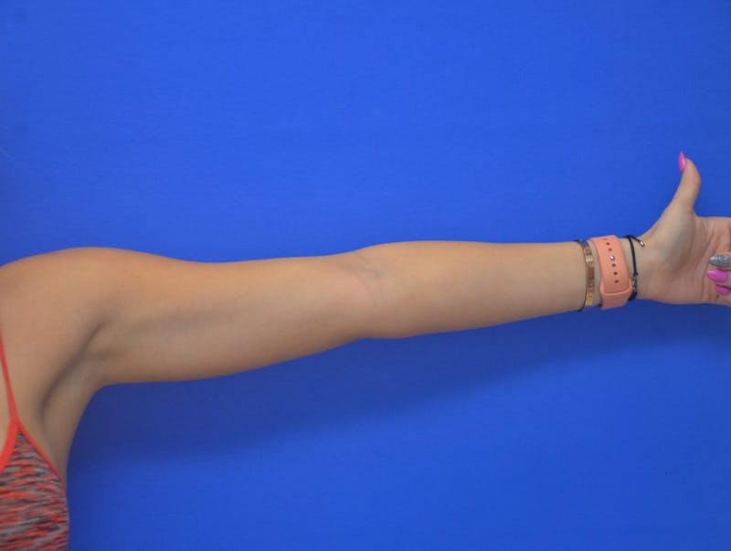 Liposuction Before & After Gallery - Patient 403247 - Image 9
