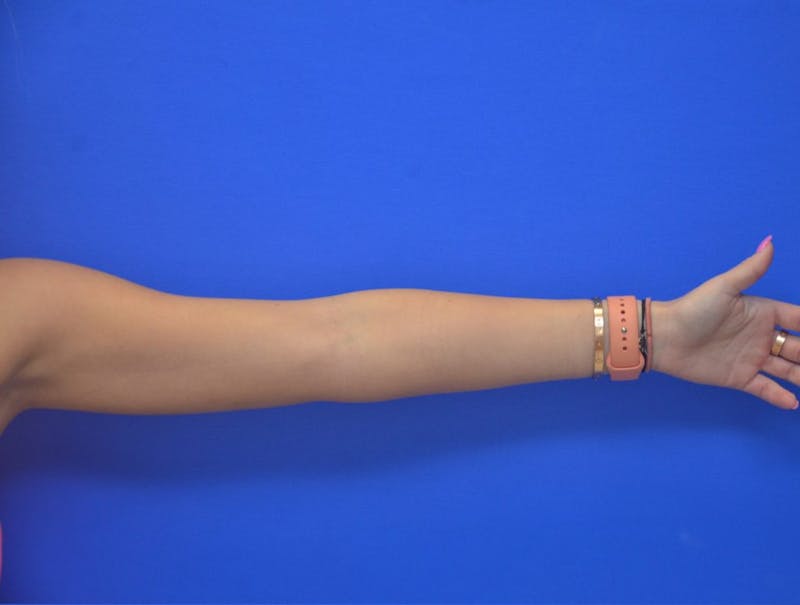 Liposuction Before & After Gallery - Patient 403247 - Image 10