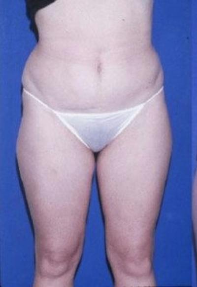 Liposuction Before & After Gallery - Patient 253905 - Image 1