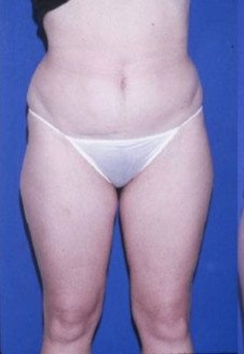 Liposuction Before & After Gallery - Patient 253905 - Image 1