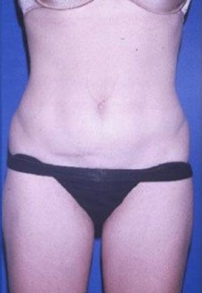 Liposuction Before & After Gallery - Patient 253905 - Image 2