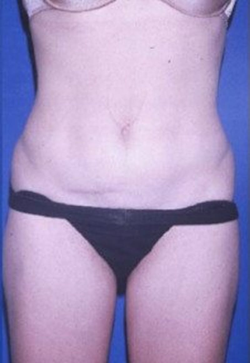 Liposuction Before & After Gallery - Patient 253905 - Image 2