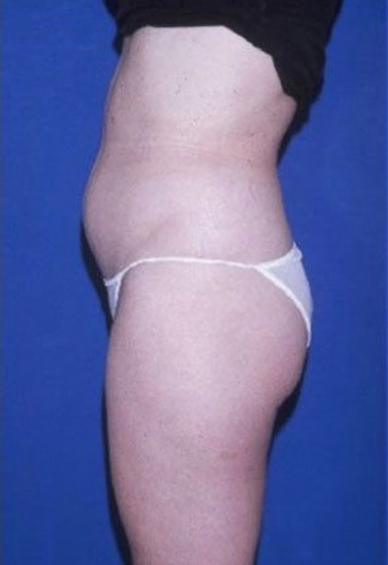 Liposuction Before & After Gallery - Patient 253905 - Image 3