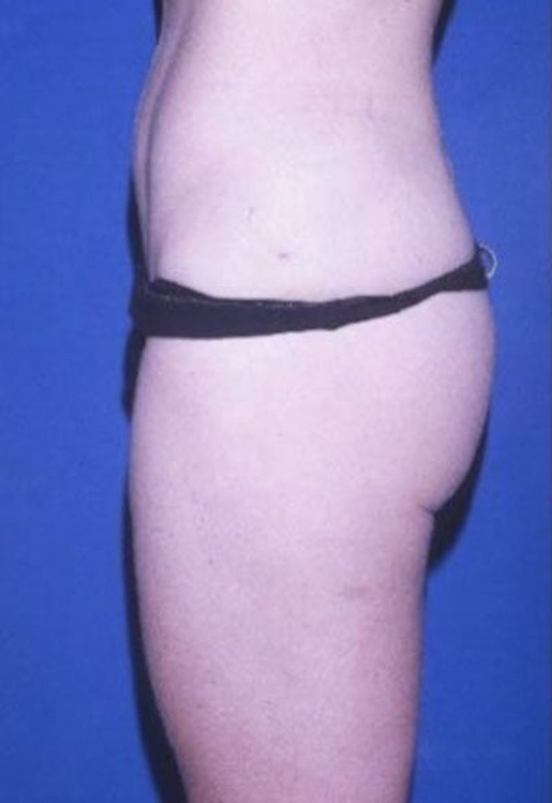 Liposuction Before & After Gallery - Patient 253905 - Image 4