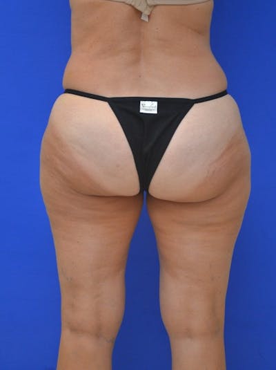 Liposuction Before & After Gallery - Patient 528742 - Image 1