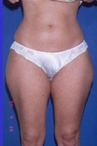 Liposuction Before & After Gallery - Patient 625525 - Image 1