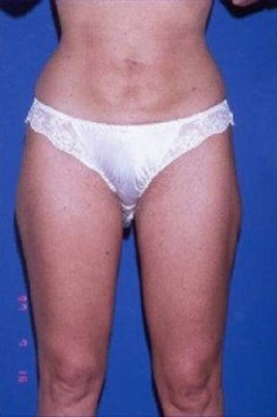Liposuction Before & After Gallery - Patient 625525 - Image 2