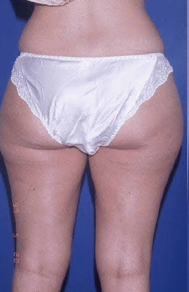 Liposuction Before & After Gallery - Patient 625525 - Image 3