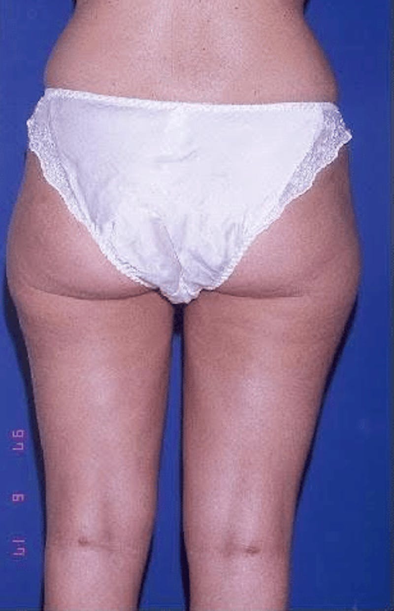 Liposuction Before & After Gallery - Patient 625525 - Image 4