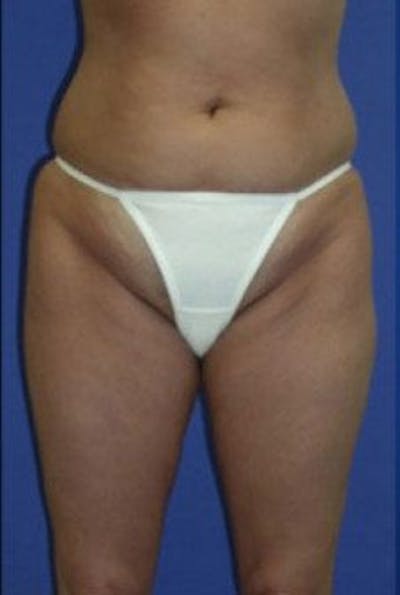 Liposuction Before & After Gallery - Patient 163002 - Image 1