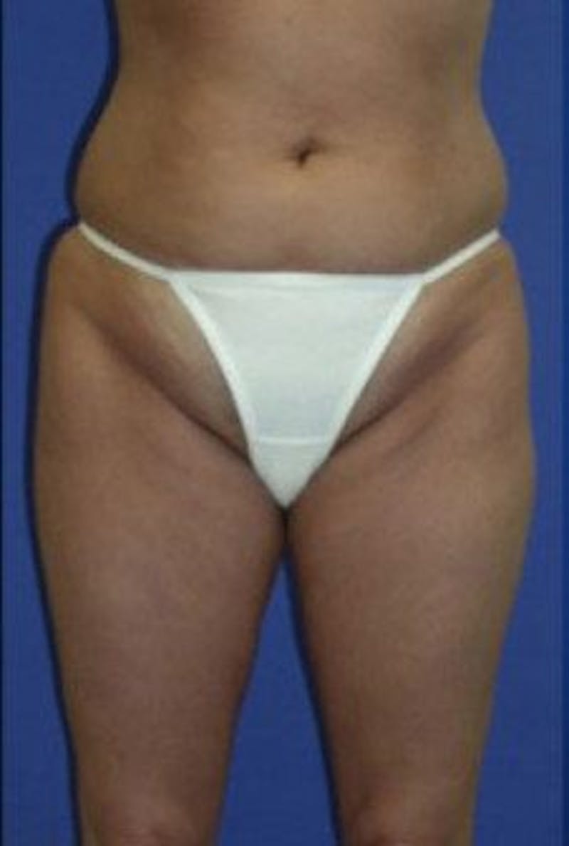 Liposuction Before & After Gallery - Patient 163002 - Image 1