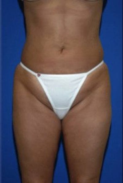 Liposuction Before & After Gallery - Patient 163002 - Image 2