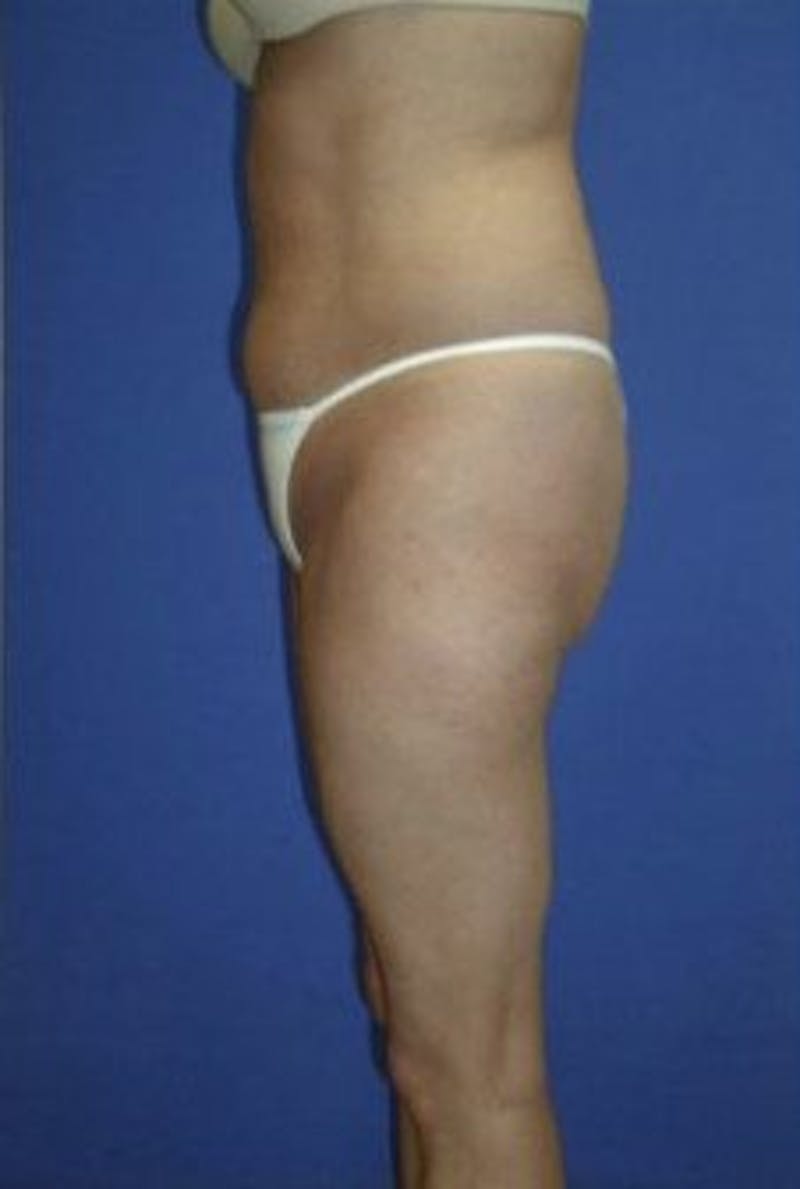 Liposuction Before & After Gallery - Patient 163002 - Image 3