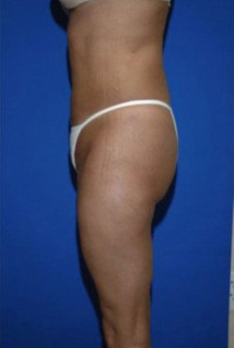 Liposuction Before & After Gallery - Patient 163002 - Image 4