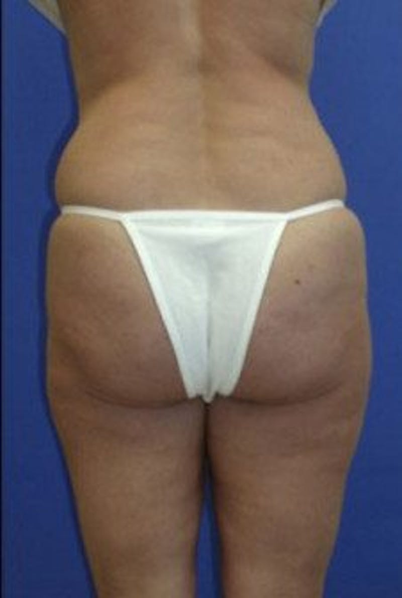 Liposuction Before & After Gallery - Patient 163002 - Image 5