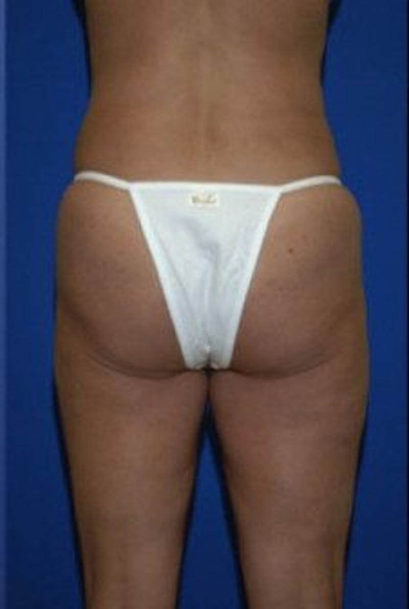 Liposuction Before & After Gallery - Patient 163002 - Image 6