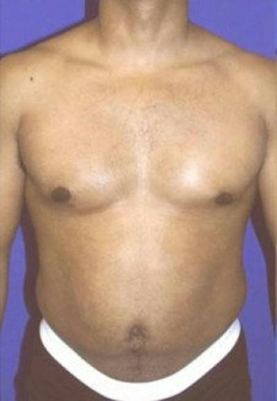 Liposuction Before & After Gallery - Patient 482114 - Image 1
