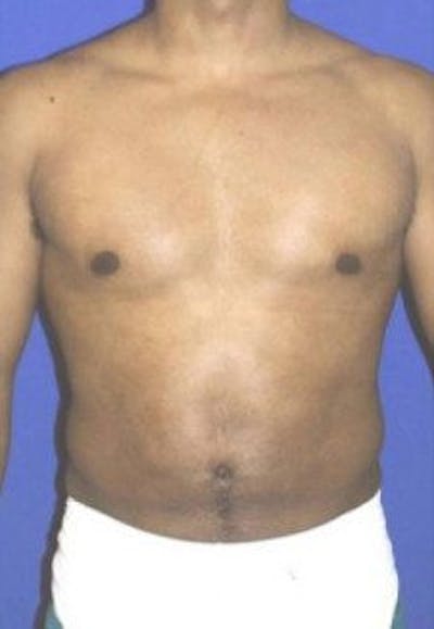 Liposuction Before & After Gallery - Patient 482114 - Image 2