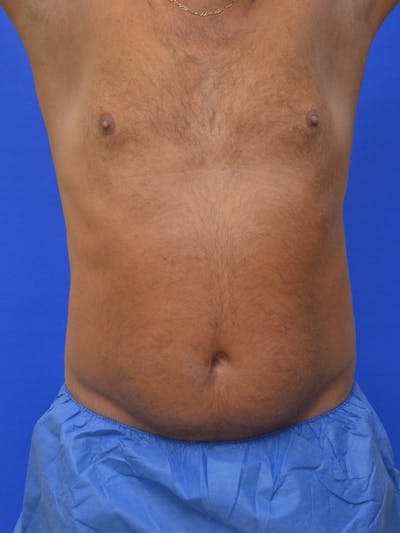 Liposuction Before & After Gallery - Patient 156381 - Image 1