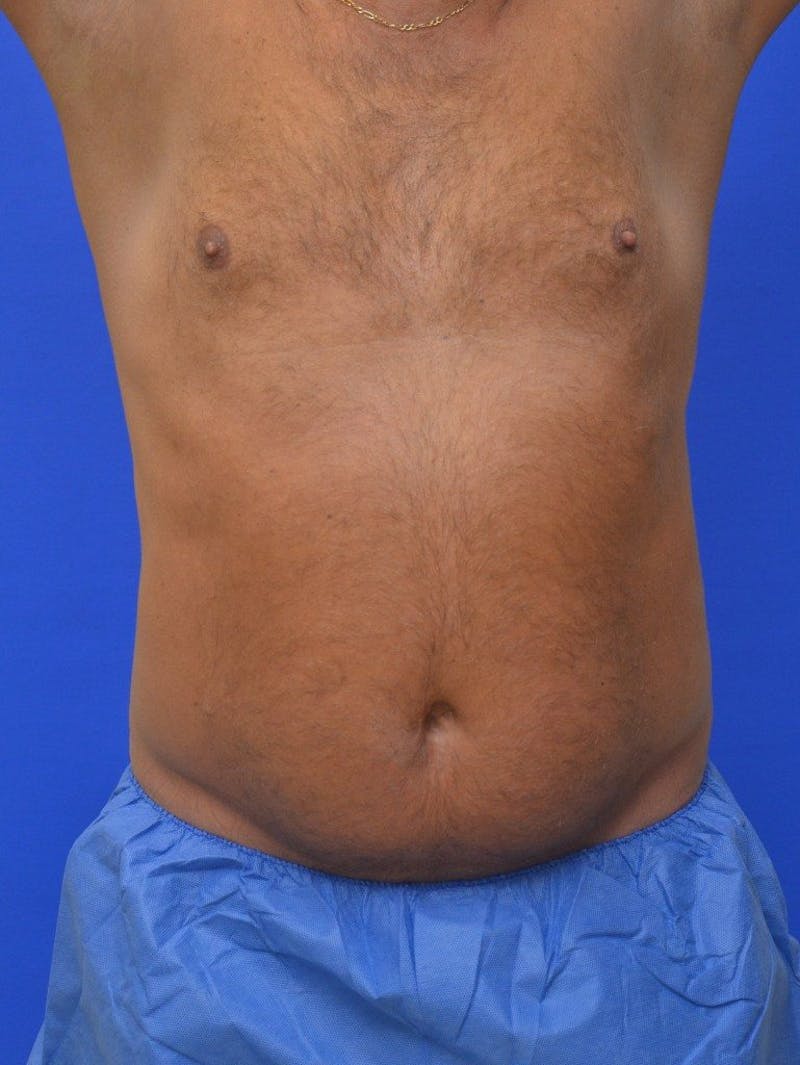 Liposuction Before & After Gallery - Patient 156381 - Image 1