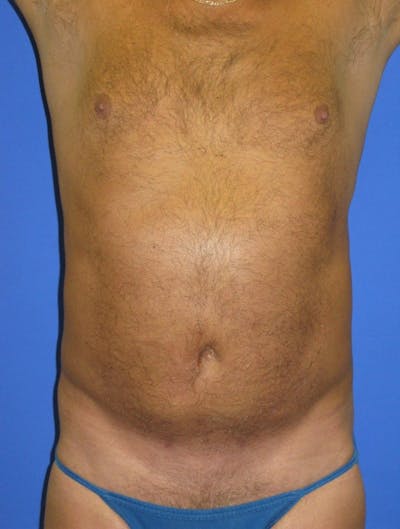 Liposuction Before & After Gallery - Patient 156381 - Image 2