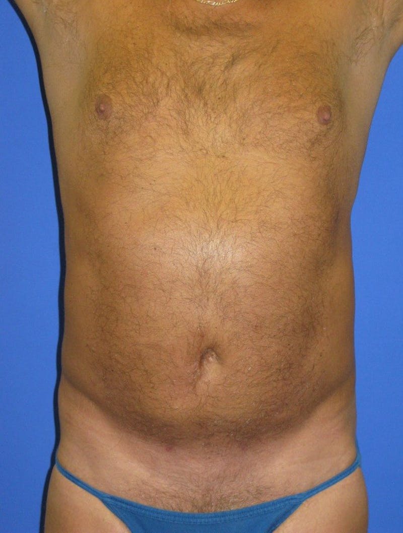 Liposuction Before & After Gallery - Patient 156381 - Image 2