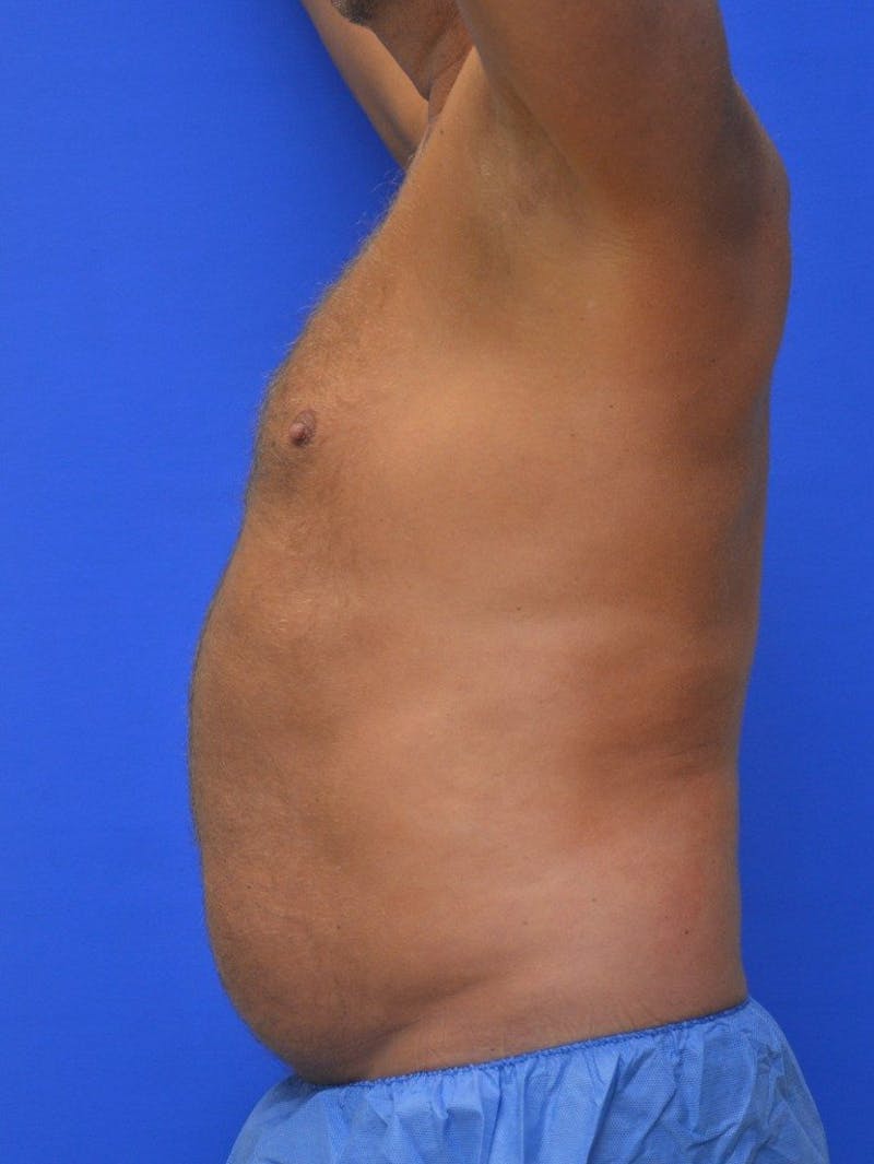 Liposuction Before & After Gallery - Patient 156381 - Image 3