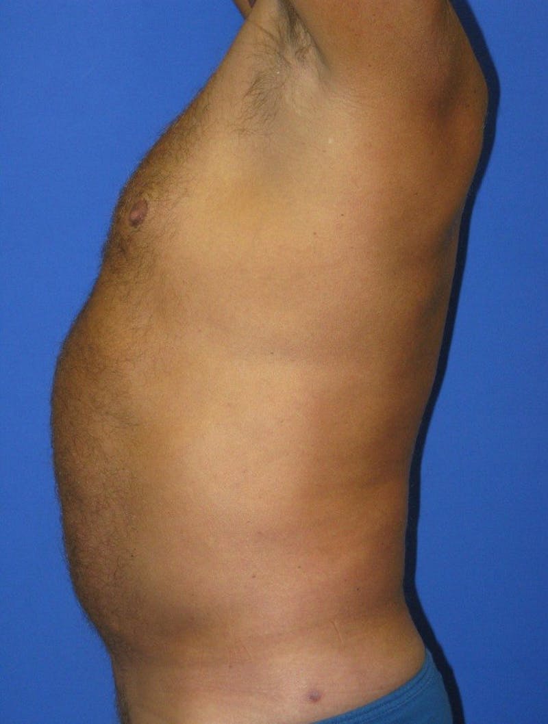 Liposuction Before & After Gallery - Patient 156381 - Image 4