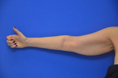 Liposuction Before & After Gallery - Patient 203408 - Image 1