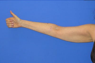 Liposuction Before & After Gallery - Patient 203408 - Image 2