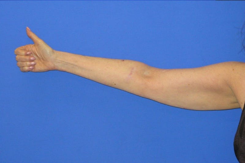 Liposuction Before & After Gallery - Patient 203408 - Image 2