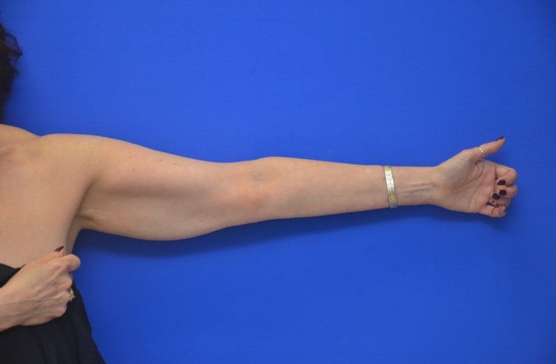 Liposuction Before & After Gallery - Patient 203408 - Image 3
