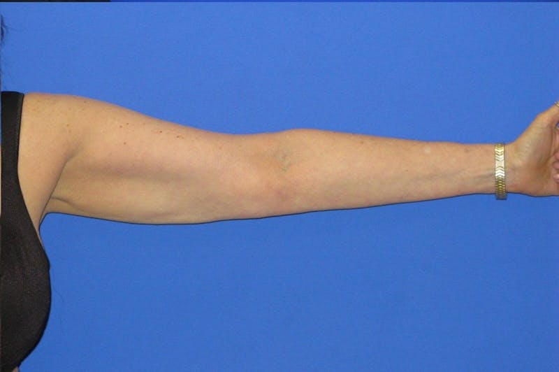 Liposuction Before & After Gallery - Patient 203408 - Image 4