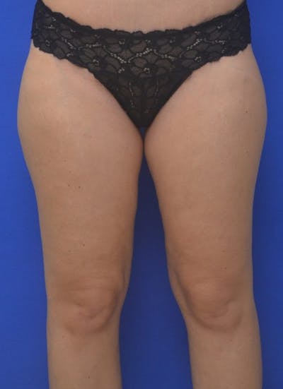 Liposuction Before & After Gallery - Patient 376059 - Image 1