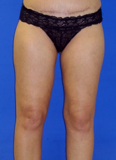 Liposuction Before & After Gallery - Patient 376059 - Image 2