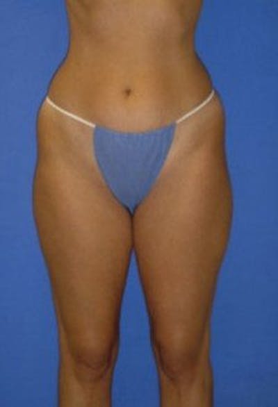 Liposuction Before & After Gallery - Patient 198742 - Image 1
