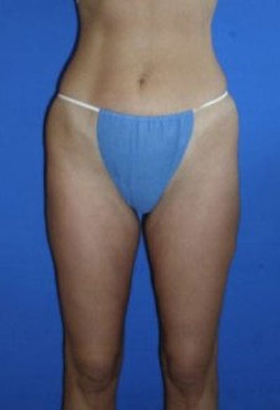 Liposuction Before & After Gallery - Patient 198742 - Image 2